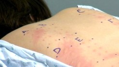 Allergy Treatment Tailored to Your Needs