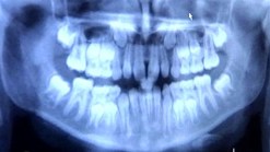 Study: No Link Between Gum and Heart Disease