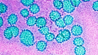 No "Sex Superbug" In the U.S., Gonorrhea Still an Issue