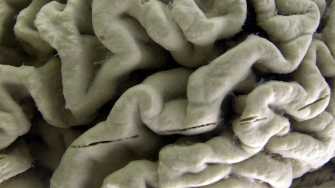 Results for Solanezumab in Mild Dementia of Alzheimer's Disease Announced