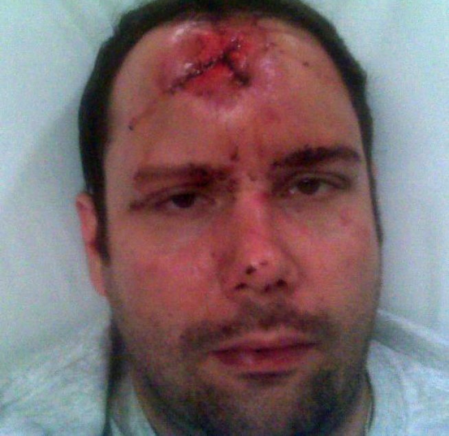 Left to Die: Gay Man Bashed on Pride Weekend