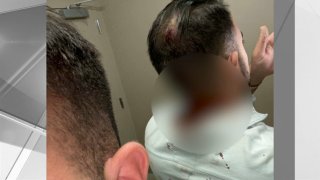 Cuts on back of man's head