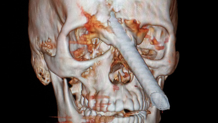 APTOPIX Brazil Bar Pierces Skull