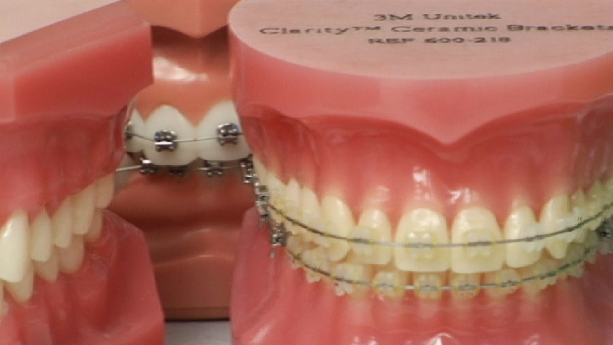 ITeam Before Rule Change, Millions for Medicaid Braces NBC New York