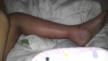Jissel's foot started to change colors.
