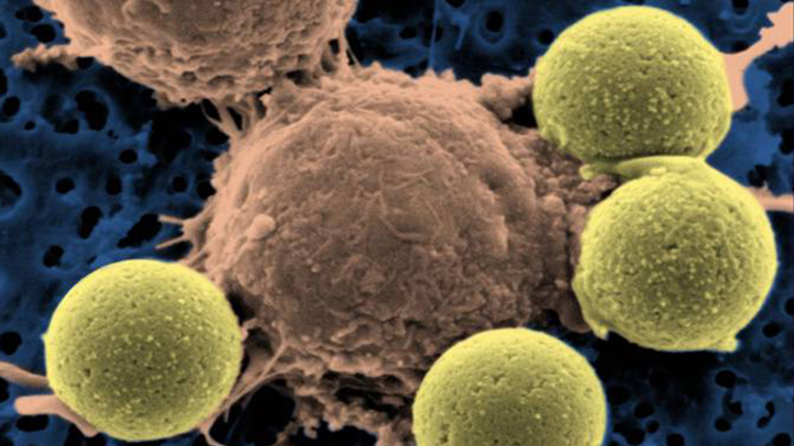 Gene Therapy Leukemia