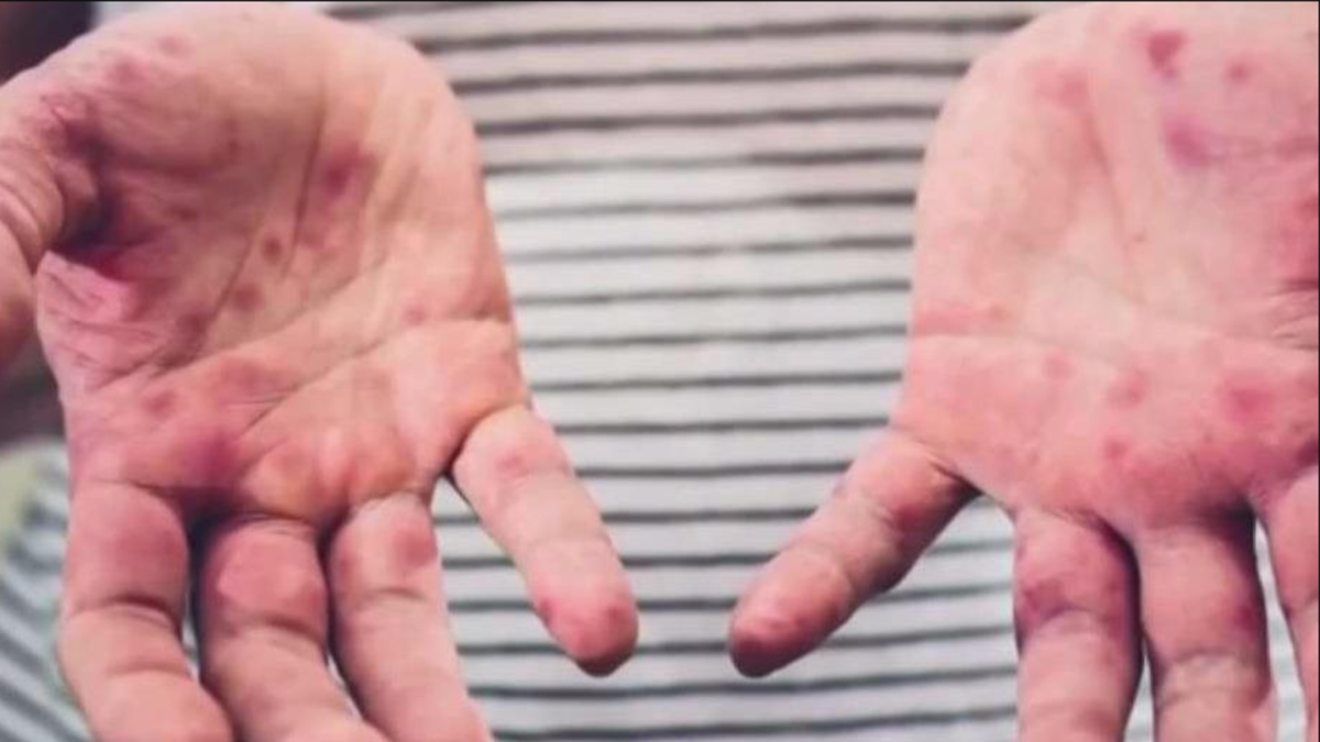 3 measles circumstances reported in NJ as youngster turns into 1st to die in Texas outbreak 3 measles circumstances reported in NJ as youngster turns into 1st to die in Texas outbreak