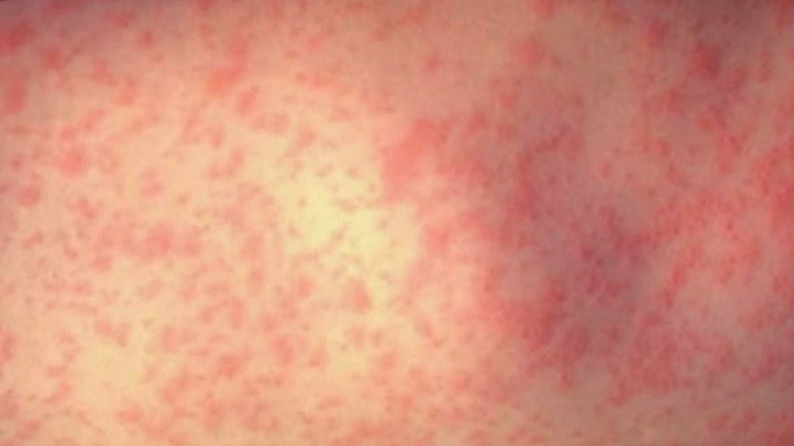 NJ Health Dept. Warns of Measles Exposure at Restaurant – NBC New York