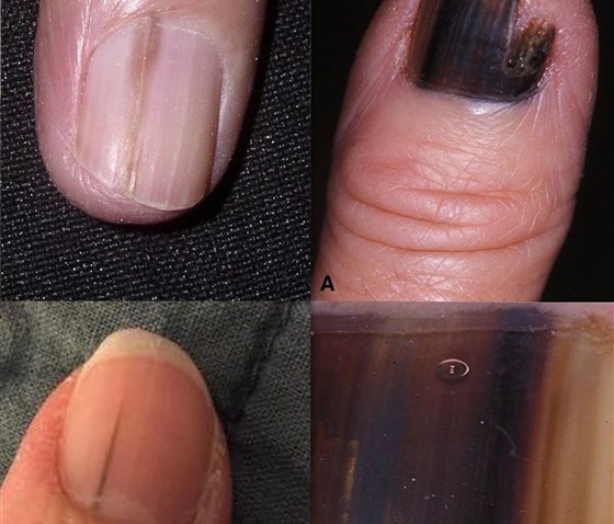 What Does Nail Melanoma Look Like Skin Cancer Can Hide As Line On Nail