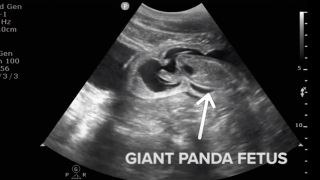 A panda fetus was spotted "kicking" on an ultrasound of the National Zoo's female giant panda, Mei XIang