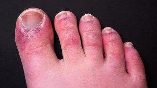 File photo of a man's foot with a rash on the toes, a common side effect of coronavirus, known as "COVID toes."