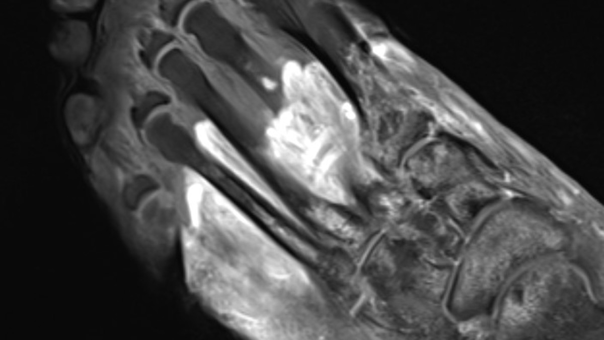 Imaging Reveals COVID Can ‘Cause the Body to Attack Itself,’ Leading to