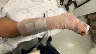 Injured correction officer's broken leg