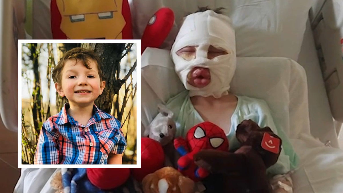 ‘Mommy They Lit Me on Fire’: CT 6-Year-Old Burned in Horrific Bully Attack, Family Says