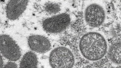 Monkeypox Outbreak Spreads in NY