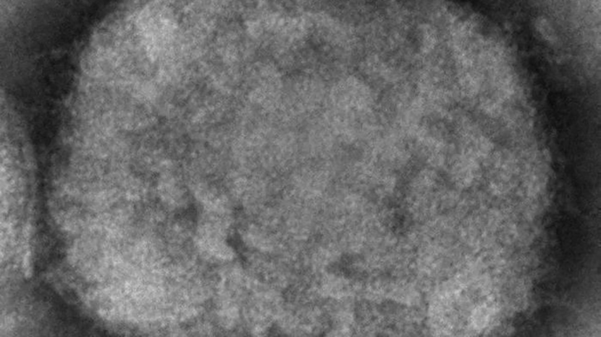 UN Health Agency Chief Declares Monkeypox a Global Emergency - Vimarsana News