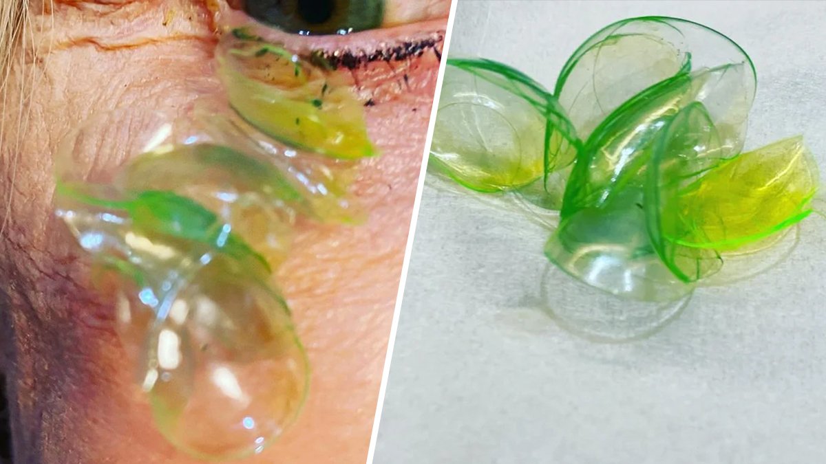 Woman Had 23 Contact Lenses Stuck Under Her Eyelid, Doctor Says – NBC New York - Vimarsana News