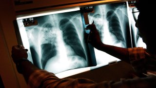 NEW YORK- NOVEMBER 27: A doctor examines the x-rays of a tuberculosis (TB) patient at a TB clinic Novmeber 27, 2002 in Brooklyn, New York. Healthcare workers around the country oversee patients in a program called Directly Observed Therapy (DOT) that ensures carriers of the tuberculosis bacteria take their medication. Tuberculosis is a contagious disease of the lungs that is spread through the air and kills around 2 million people annually, mainly in third world countries. It is relatively easy and affordable to treat, with a six-month series of drugs costing around 10 dollars. While the number of TB cases in the United States has dropped in recent years, the disease is still particularly strong among the foreign-born, the homeless and impoverished contributing to the deaths of thousands of Americans yearly. As of 2000, over 16,000 Americans have contracted tuberculosis. (Photo by Spencer Platt/Getty Images)