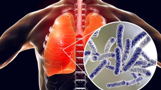 illustration showing legionella bacteria in the lungs
