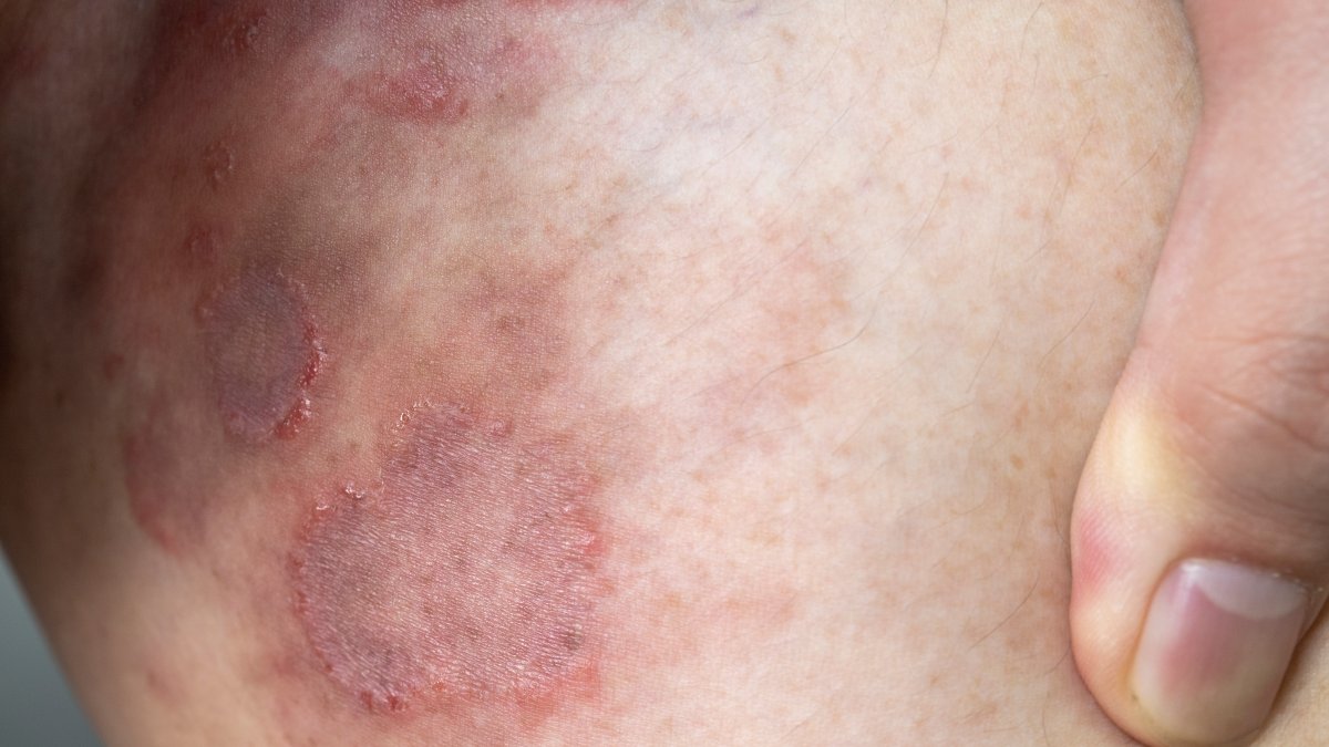 NYC Tinea Cases: First Resistant Ringworm Infections Detected in United States – NBC New York - Vimarsana News