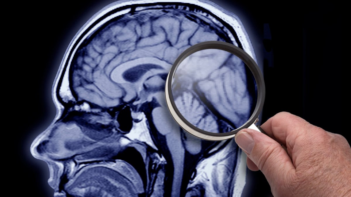 Health insurance companies may not cover new Alzheimer's drug Leqembi – NBC New York - Vimarsana News
