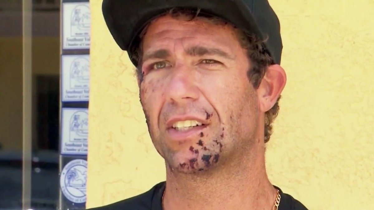 Surfer recalls getting bit in the face by shark at Florida beach – NBC New York - Vimarsana News