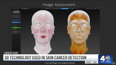 3D technology used in skin cancer detection