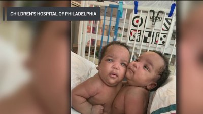 Conjoined twins return home after successful separation surgery at CHOP