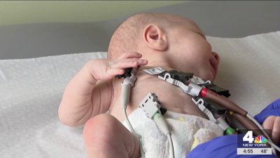 Baby on Long Island receives the world's smallest pacemaker