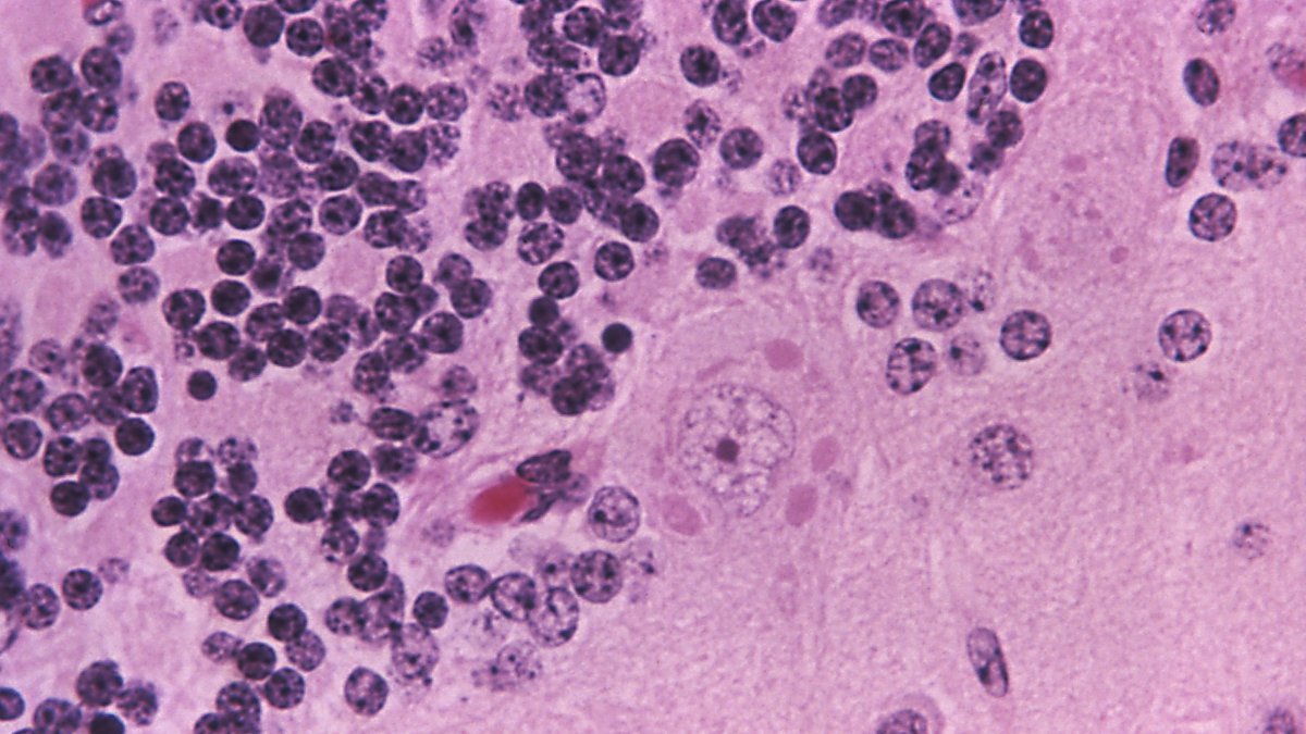 Michigan patient dies after contracting rabies through a transplanted ...