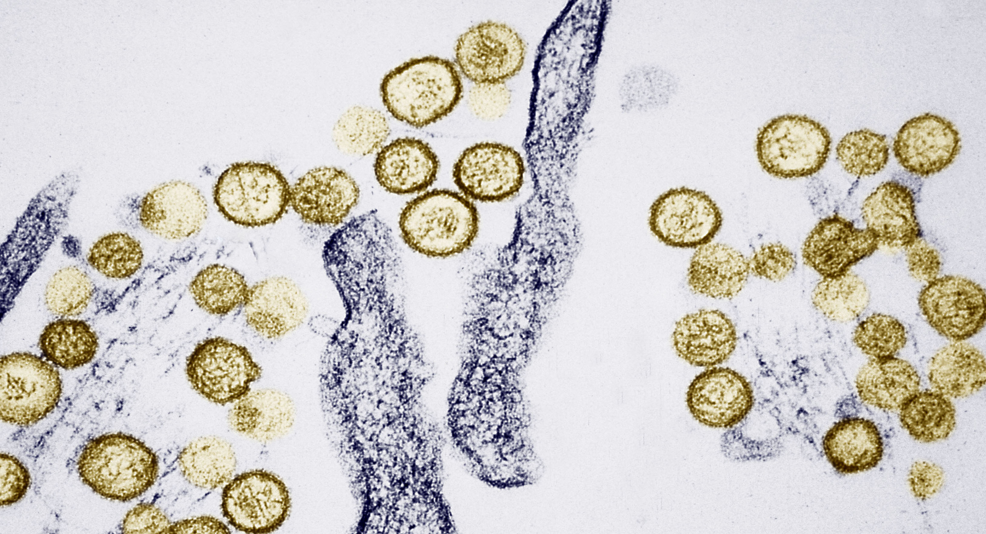 What’s hantavirus? The rodent-borne illness officers say killed Gene Hackman’s spouse What’s hantavirus? The rodent-borne illness officers say killed Gene Hackman’s spouse
