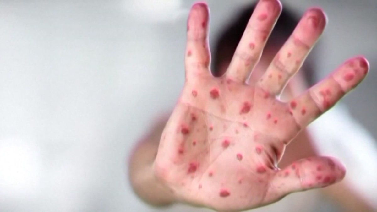 Measles Alert! NYC Health Officials Warn of Possible Exposure in Manhattan