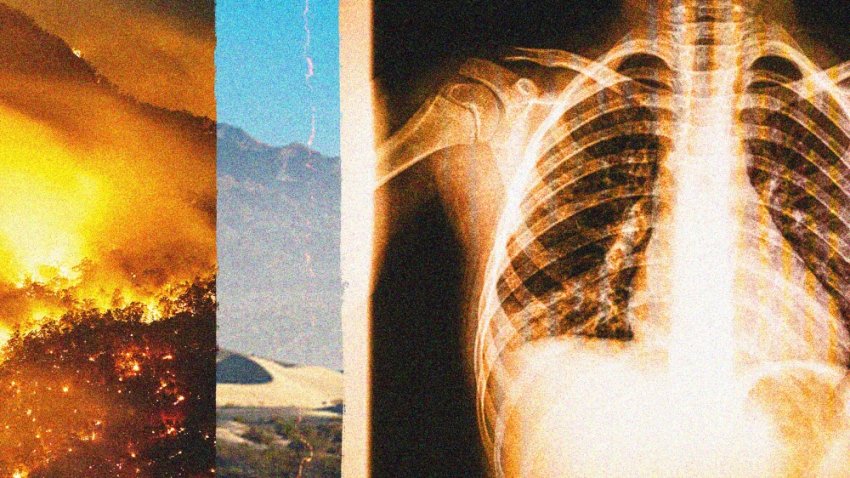 Valley fever is caused by inhaling coccidioides spores, a type of fungus endemic to the hot, dry climate of the southwestern United States.