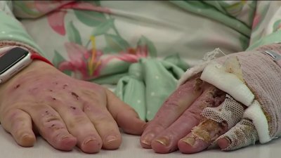 Woman shares story of survival after Fort Lauderdale boat explosion