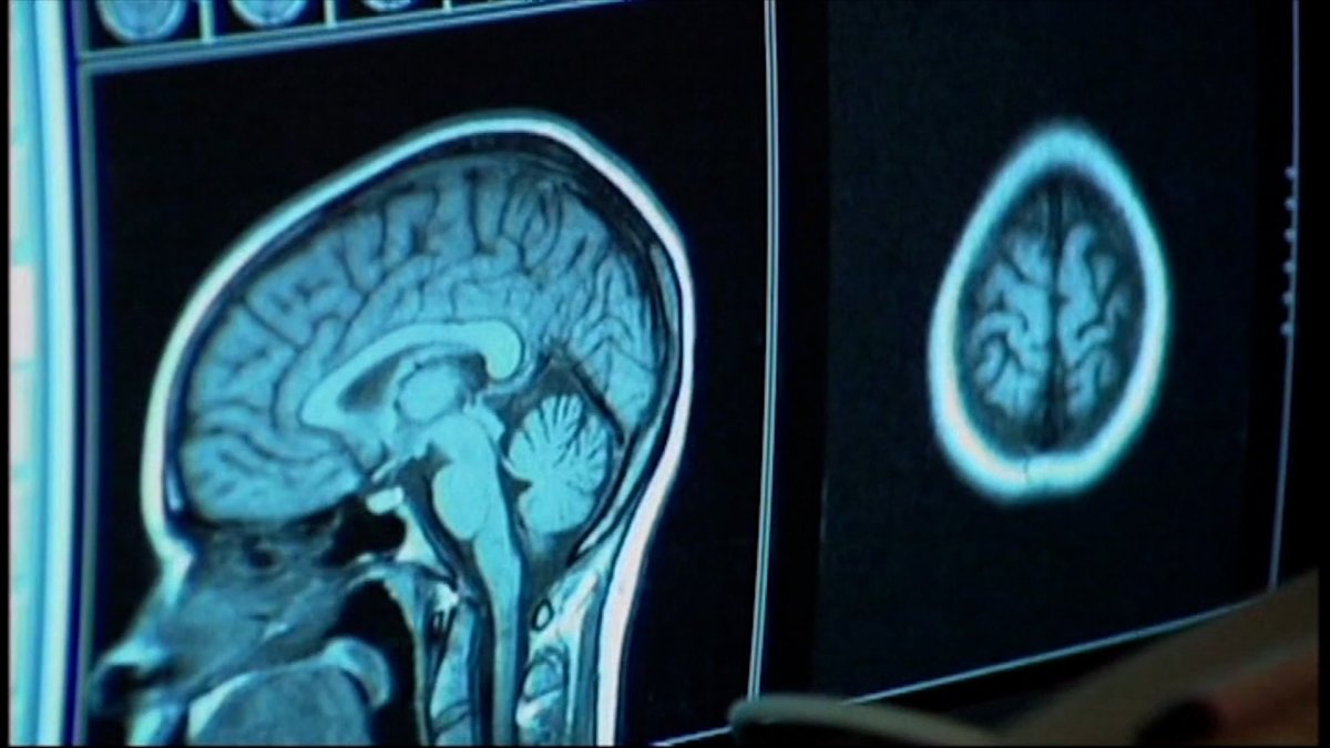 What is a concussion? Watch how CTE affects the brain – NBC New York