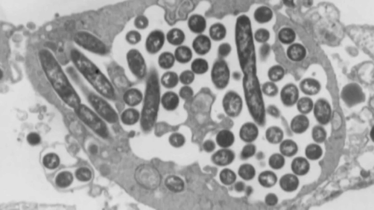 Legionnaires' Disease Clusters Rise in Marshall County Iowa, Westchester County New York