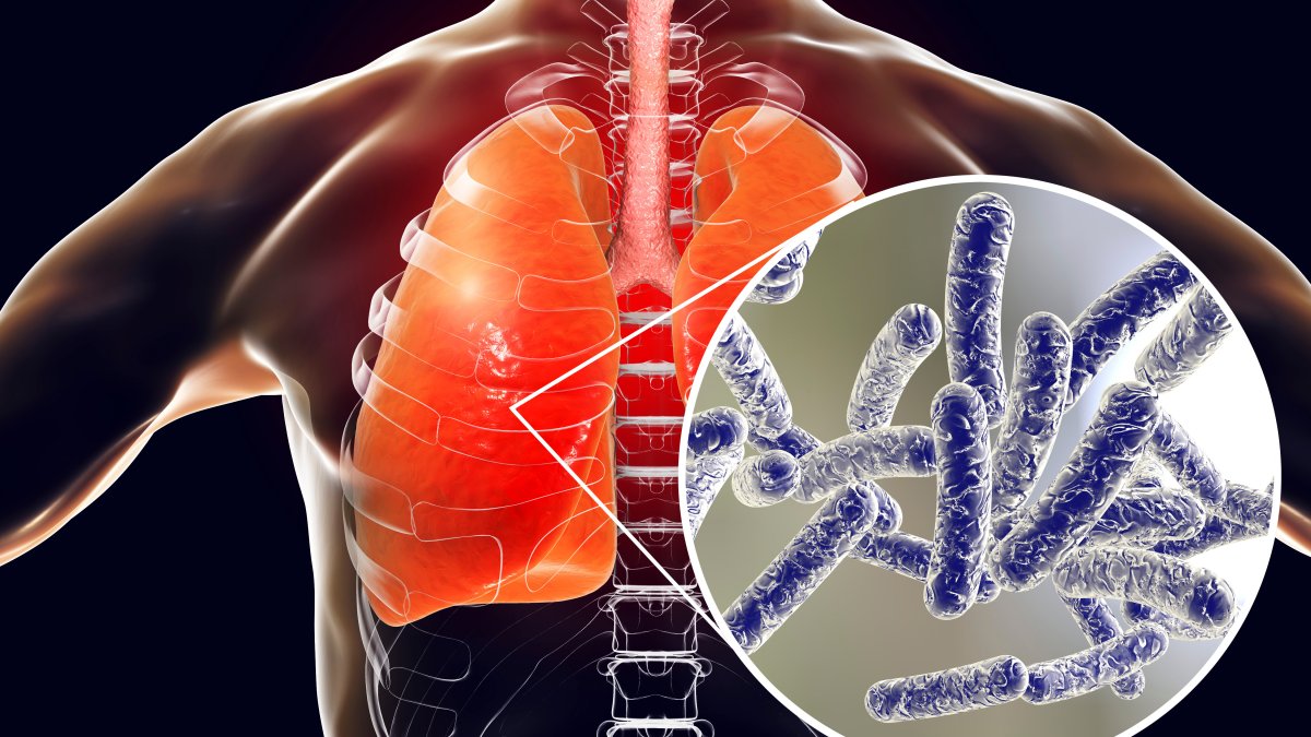 Veja como se inscrever no Legionnaires’ Disease Cluster Town Hall de segunda-feira à noite – NBC Nova York