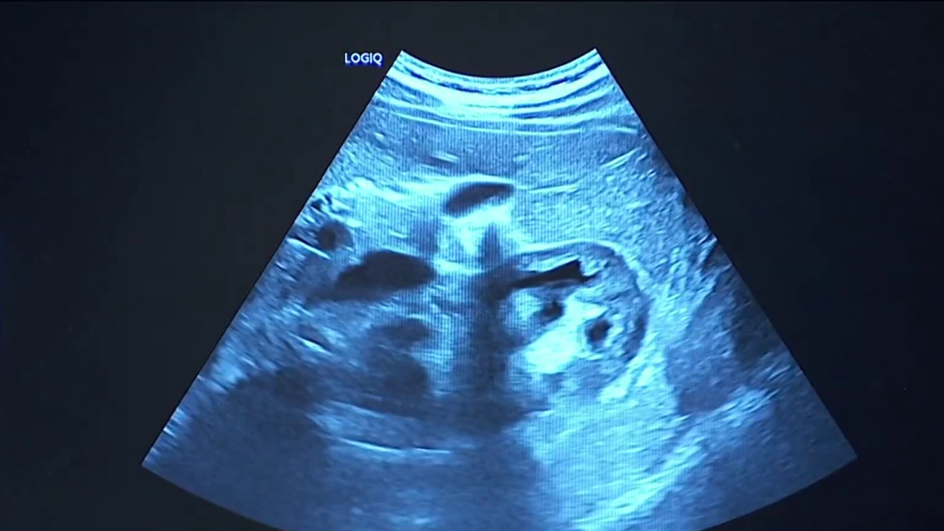 nbcnewyork.com - Long Island medical student learns about alarming kidney issue during class