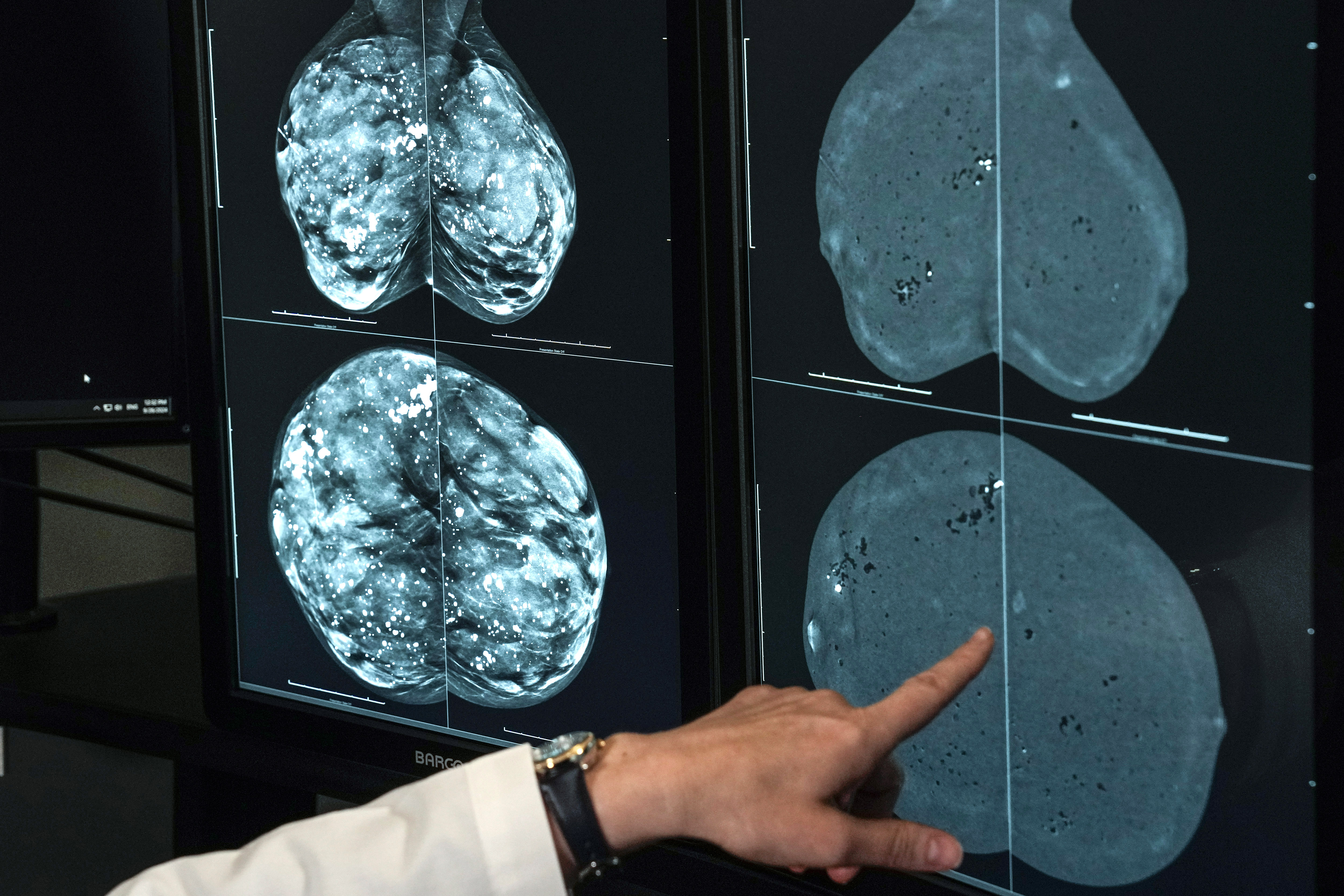 When should you get a mammogram? Conflicting advice makes it hard to know