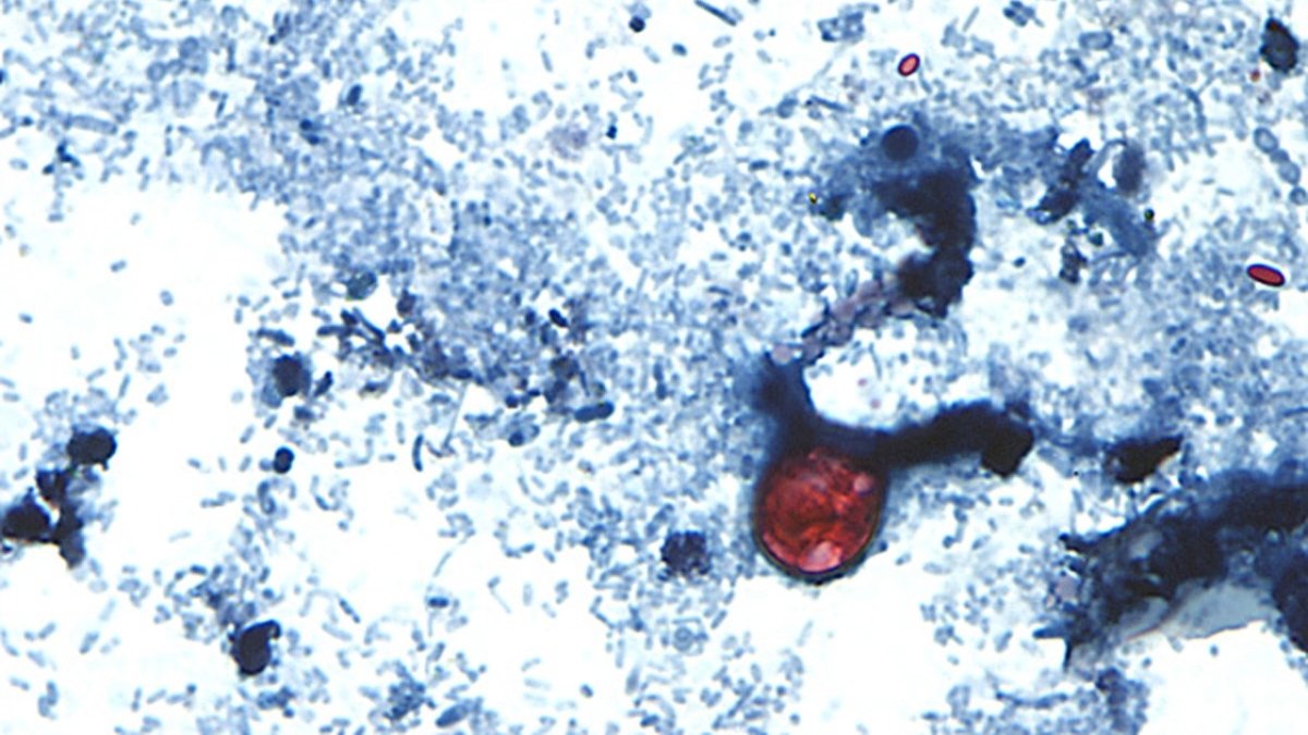 Cyclospora em Nova York aumenta para 394 casos desde 1º de maio – NBC New York