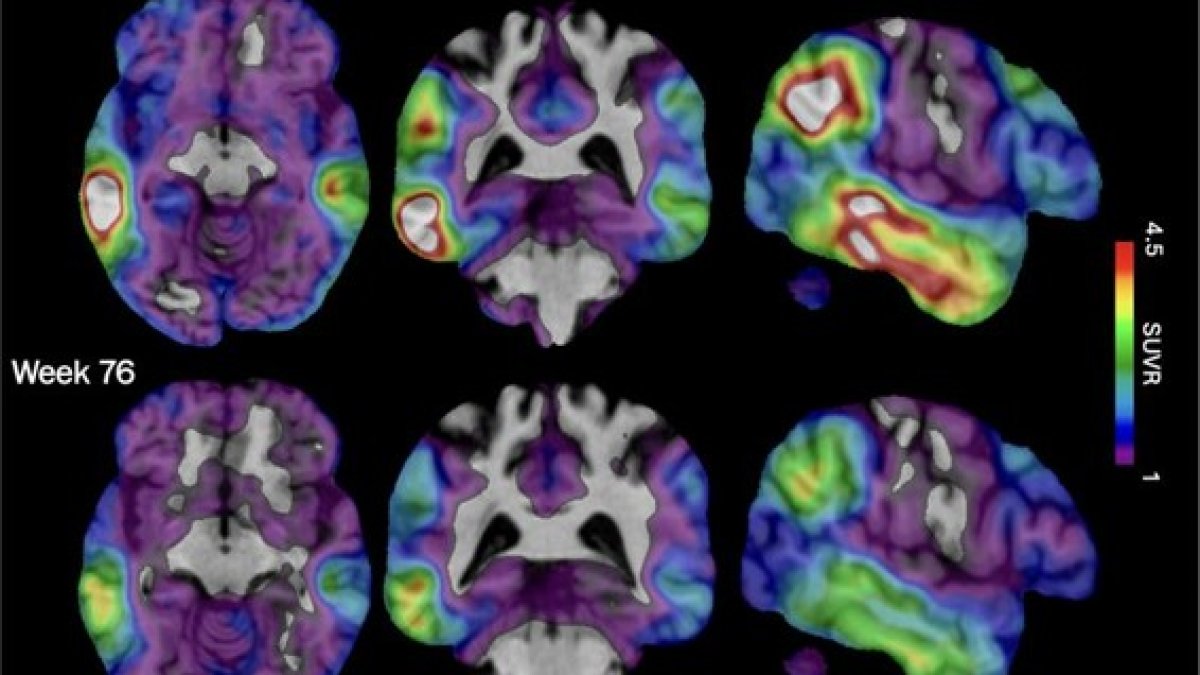 Experimental Alzheimer's drug shows promise targeting brain protein tau in study