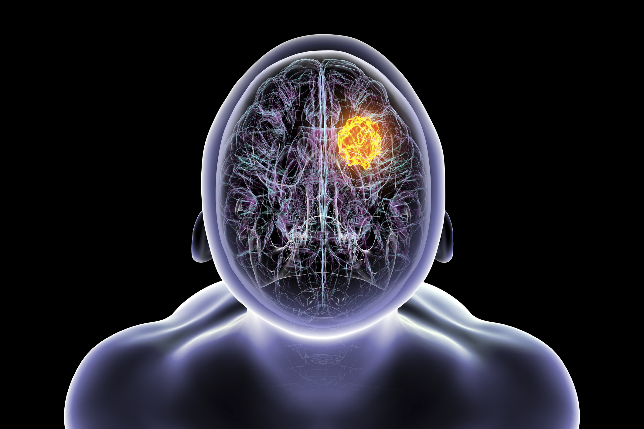 How a doctor monitors herself for glioblastoma and the most common symptom