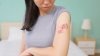 Shingles plummets among younger adults but is mysteriously rising in another group